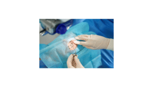 Deep Anterior Lamellar Keratoplasty (DALK)