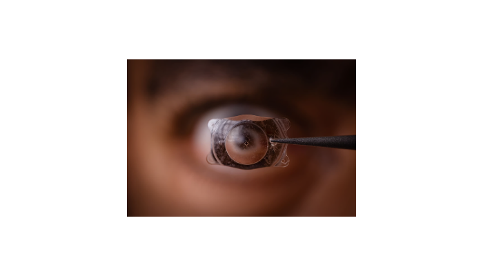 Corneal Transplantation