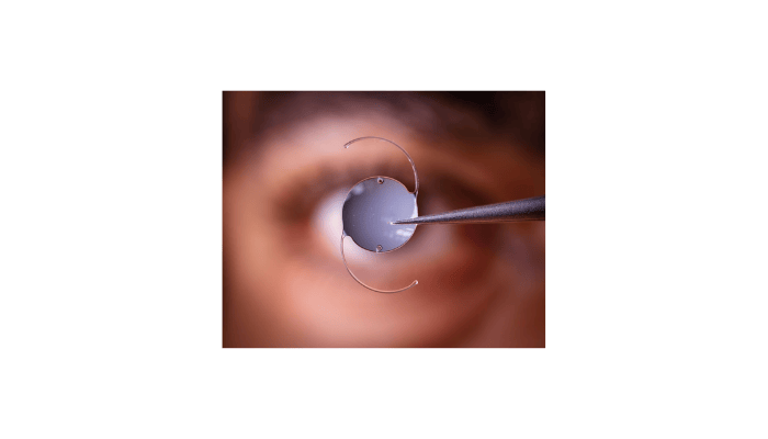 Descemet Membrane Endothelial Keratoplasty (DMEK)