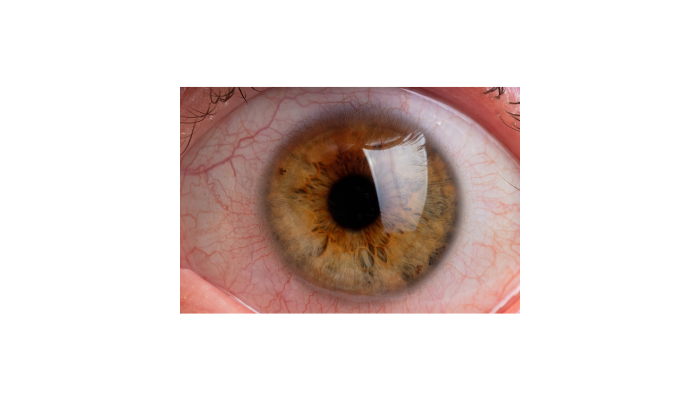 Epithelium-On (Epi-On) C3R
