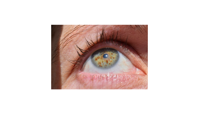Keratoconus