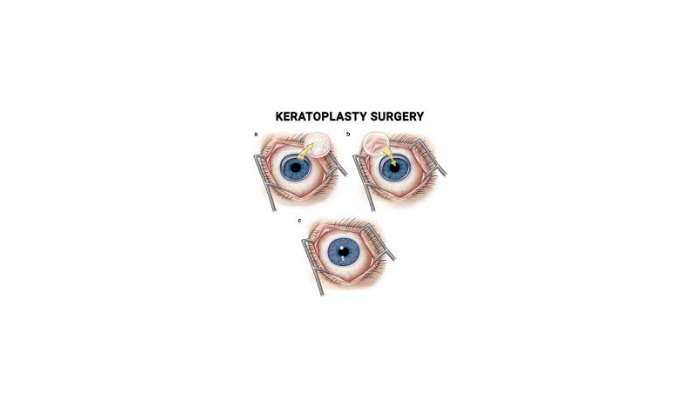 Keratoplasty (Corneal Transplant)