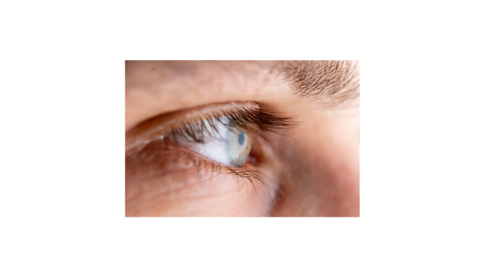 Stopping the Keratoconus Progression