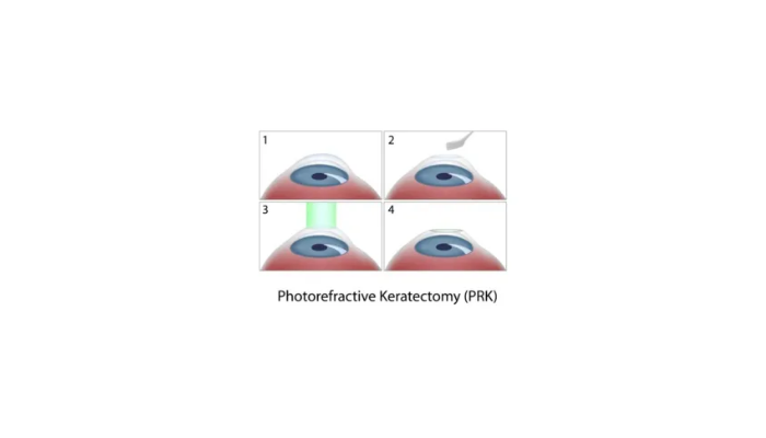 Topography-Guided Photorefractive Keratectomy (PRK)