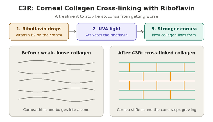 What is C3R - riboflavin drops and UVA light create collagen cross-links that stiffen the cornea in keratoconus